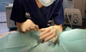 Introducción del catéter por la aguja epidural
