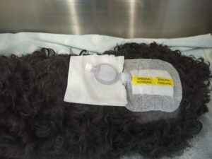 Protección del catéter epidural mediante apósito estéril.