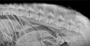 Catéter epidural con varios bucles en su recorrido.