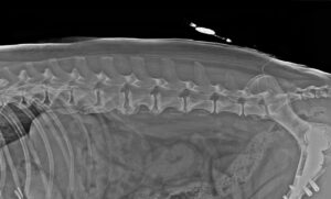 Catéter epidural con un bucle a la altura de L6-L7