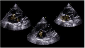 ba2 hurones 7 jpg Parásitos adultos de Dirofilaria immitis, utilizando una vista ecocardiográfica apical de 4 cámaras paraesternal izquierda.