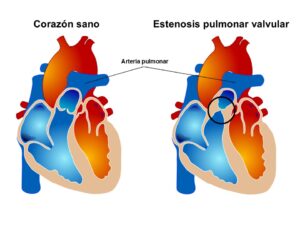 Imagen 1. Esquema comparativo de un corazón sin alteraciones anatómicas y uno con la presencia de estenosis pulmonar valvular.