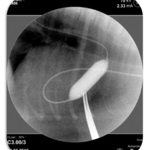 ba2 pulmonar 3 jpg Imagen 3. Imagen fluoroscópica de una valvuloplastia pulmonar donde observan el balón hinchado durante la dilatación valvular