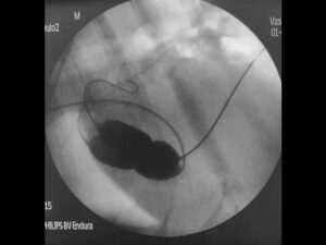ba2 pulmonar 4 jpg Imagen 4. Imagen fluoroscópica de una valvuloplastia pulmonar donde se utiliza la técnica de doble balón.