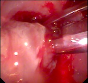 Extracción de un adenoma hipofisario.