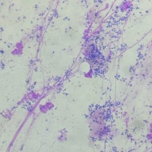 Imagen citológica de una infección bacteriana en el oído de un perro.