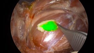 Nódulo linfático una vez reseccionado.