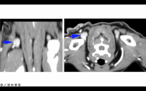 ba3 sapi imagen3 TC de la región cérvico-torácica de la paciente (derecha: plano transversal; izquierda: plano coronal). Las flechas azules señalan el linfonodo cervical.