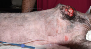 Tumor ulcerado