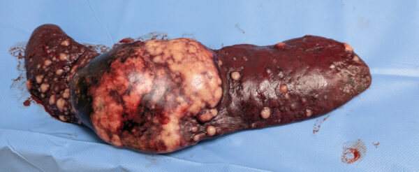 Imagen 2. Bazo canino con neoplasia avanzada, que muestra múltiples nódulos metastásicos y un gran tumor primario ba4 onco imagen2.jpg