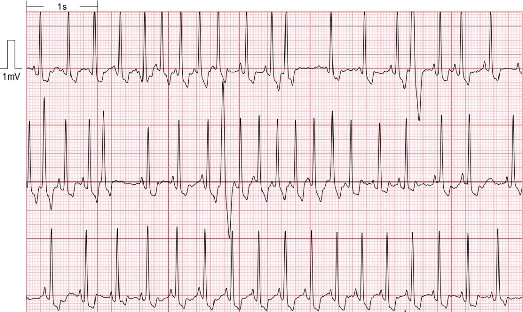 ba5 ECG imagen1