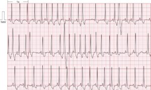 ba5 ECG imagen1