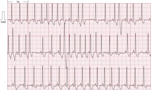 ba5 ECG imagen1