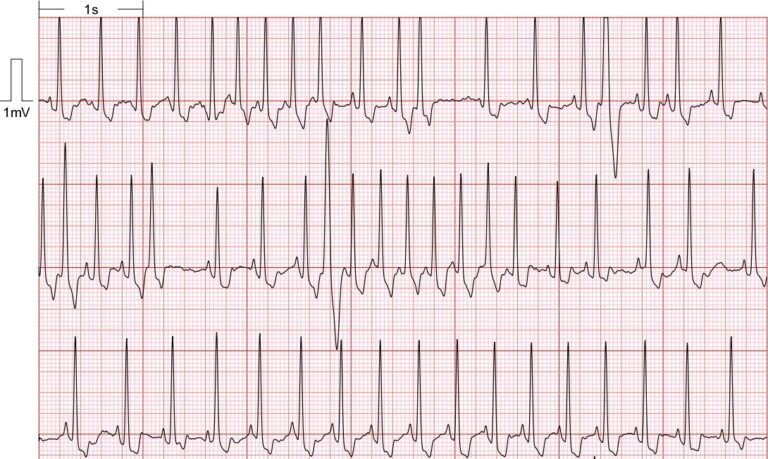 ba5 ECG imagen1