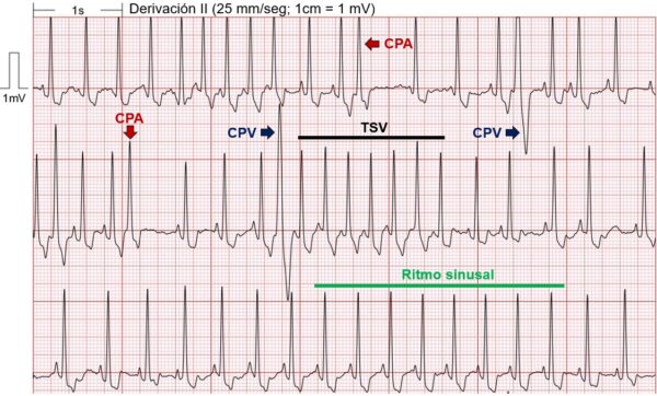 ba5 ECG imagen con interpretación