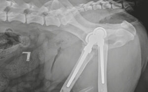 ba5 cadera imagen6.jpg