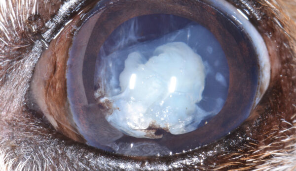 Catarata hipermadura. Catarata hipermadura.