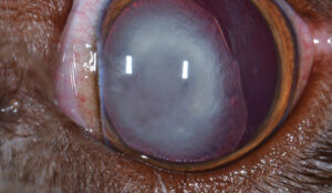 Coloboma de cristalino.