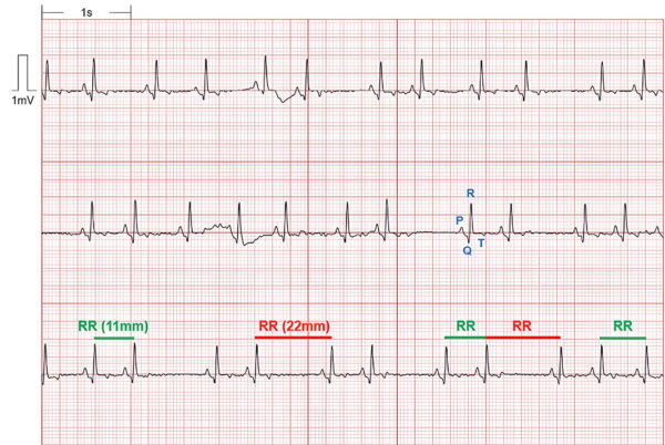 ECG. Arritmia sinusal respiratoria en bulldog francés