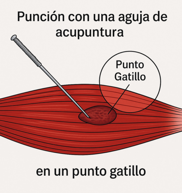 Tratamiento de PGM con punción seca.