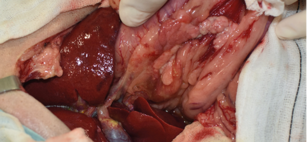 Imágenes quirúrgicas de la colocación y fijación de un stent temporal en la papila duodenal mayor en un perro, accediendo mediante una duodenotomía, por una pancreatitis y obstrucción biliar (colédoco) secundaria.