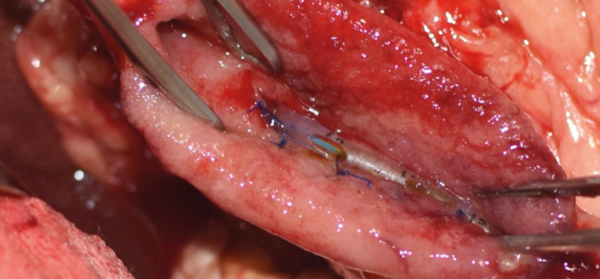 Imágenes quirúrgicas de la colocación y fijación de un stent temporal en la papila duodenal mayor en un perro, accediendo mediante una duodenotomía, por una pancreatitis y obstrucción biliar (colédoco) secundaria.