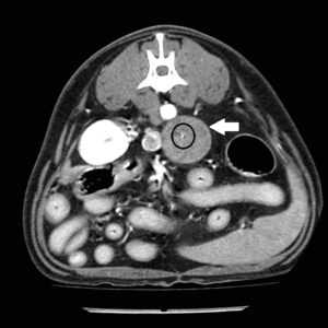 Imagen de TC en plano transversal en ventana de tejidos blandos tras la administración de contraste en fase venosa (B) de un adenocarcinoma (flecha blanca)