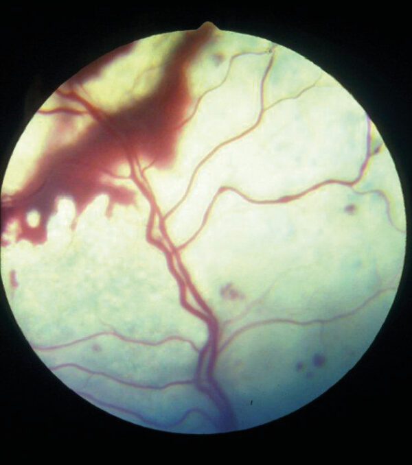 Fondo de ojo de un gato con retinopatía hipertensiva, caracterizado por la presencia de una gran hemorragia subhialoidea, hemorragias multifocales puntiformes, exudado subretiniano (desprendimiento de retina plano) y vasculopatía hipertensiva.