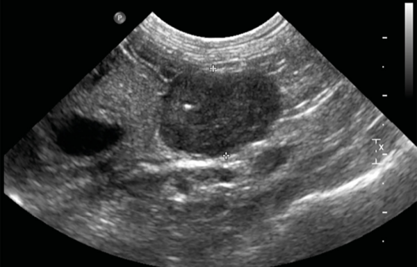 Imagen ecográfica de una masa adrenal derecha en un gato con hiperaldosteronismo primario.