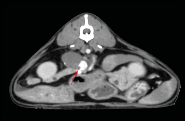 Imagen de tomografía computarizada de una masa adrenal derecha con invasión de la vena cava caudal en un gato con hiperaldosteronismo primario.