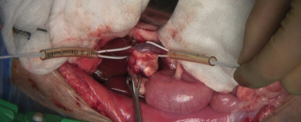 Imagen intraoperatoria de una masa adrenal derecha con invasión de la vena cava caudal antes de su oclusión con torniquetes de Rumel para su escisión 