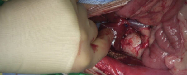 Imagen intraoperatoria tras la escisión de la masa adrenal y el trombo tumoral y cierre de la cavotomía.