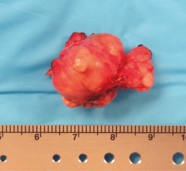 Masa adrenal derecha (carcinoma adrenocortical en histopatología) tras su escisión. 
