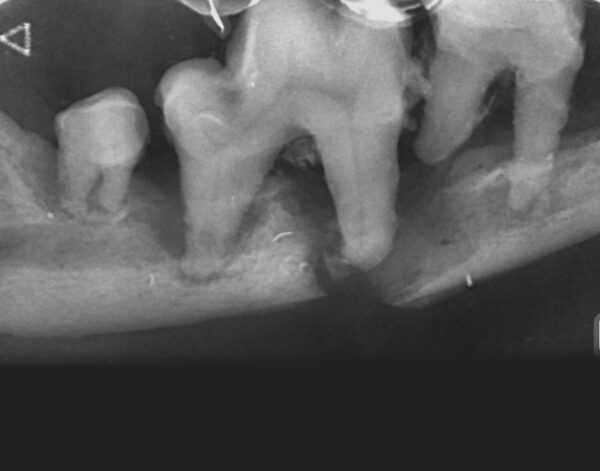 Fracturas iatrogénicas del cuerpo mandibular a nivel del primer molar (409) por enfermedad periodontal grado 4 en dos perros de talla pequeña.