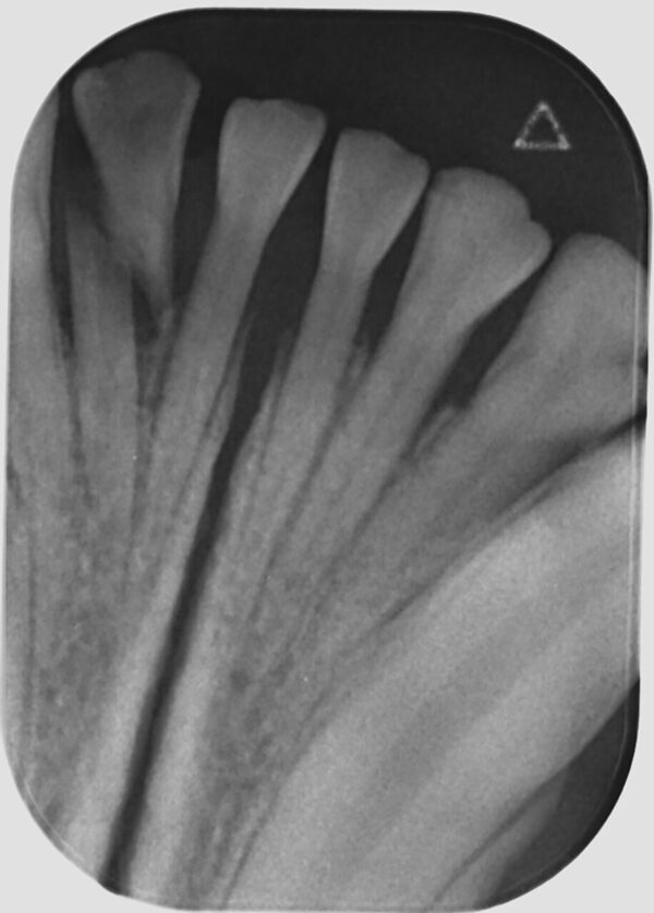 Fractura de la raíz en un segundo incisivo mandibular (402) en un perro. Su tratamiento es la extracción.