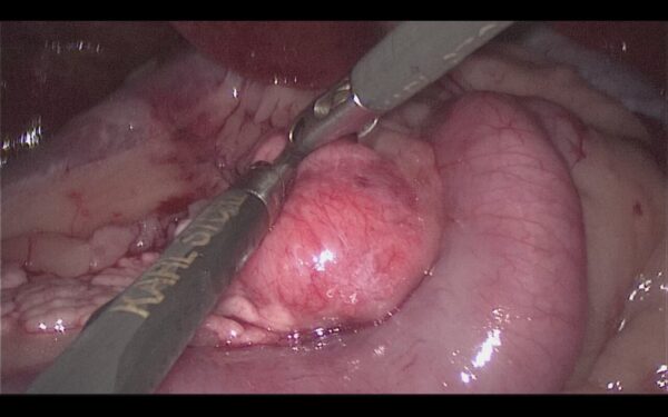 Vista quirúrgica durante la toma de una biopsia pancreática laparoscópica de un nódulo en el lóbulo pancreático izquierdo en un perro. 