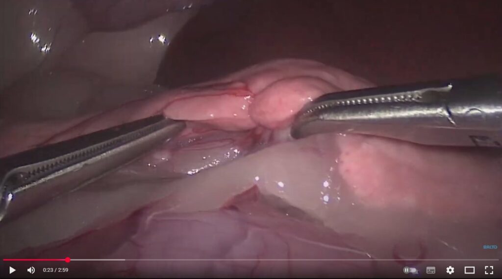 Video de una cirugía del páncreas mostrando el procedimiento quirúrgico