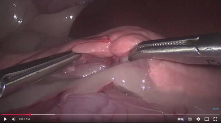 Video de una cirugía del páncreas mostrando el procedimiento quirúrgico