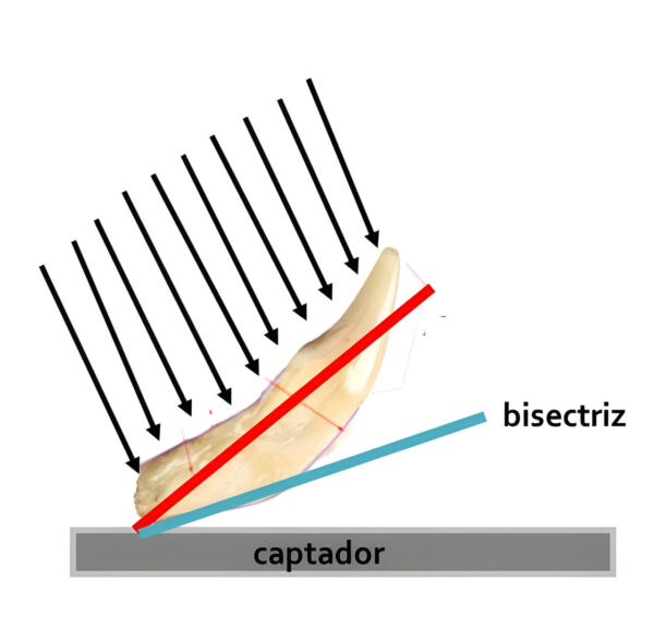 Diagrama que muestra la bisectriz y un captador en odontología.