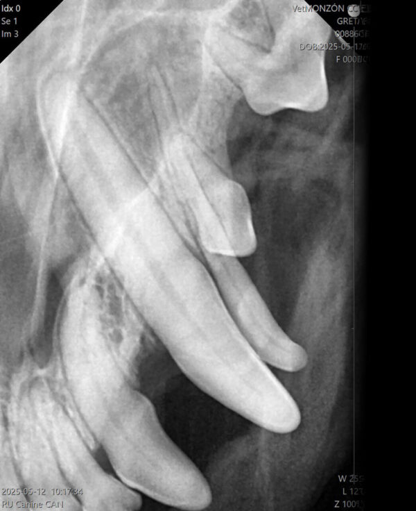 La radiografía no solo permite diagnosticar la presencia de un primer premolar maxilar (105) de más, sino que además se trata de un diente suplementario o complementario, ya que tiene una forma completamente normal (flecha).