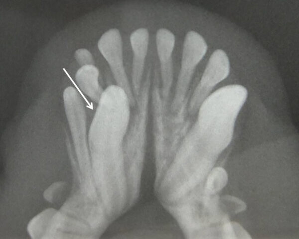 Chihuahua que ha hecho todo el recambio dental a excepción del canino mandibular derecho (404). Se observa retención del canino deciduo (804). La radiografía nos indica que el canino permanente se encuentra incluido (flecha).