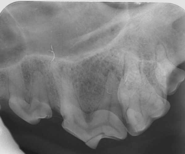 Fractura de corona del cuarto premolar maxilar (208) en un perro en la que podemos observar discontinuidad en la cúspide coronal, así como un ligero aumento del tamaño de la cámara pulpar.