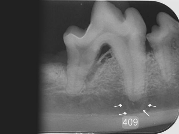 Primer molar mandibular (409) en un perro con EP grado 3 en la raíz mesial con pérdida de estructura ósea y exposición de la furca