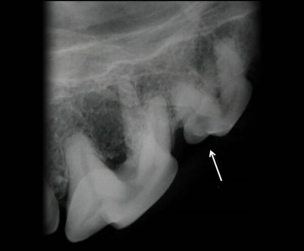 Lesión radiolúcida por pérdida de esmalte en el surco del tercer premolar maxilar (107), correspondiente a una caries. Se observa a nivel de la furca del cuarto premolar (108) una pérdida del hueso interradicular.