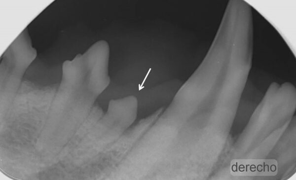 Radiografía intraoral en la que se puede ver que el premolar mandibular ha quedado incluido (flecha).