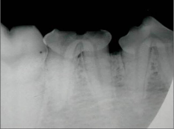 Fractura complicada de un cuarto premolar mandibular (304) en un perro en la que se observa una fractura horizontal complicada en el tercio medio-distal con pérdida de gran parte de la corona y exposición de la cámara pulpar.