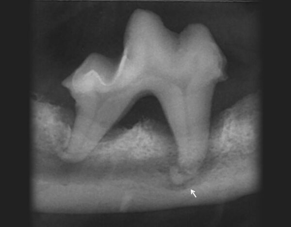 Aspecto de un primer molar mandibular (409) con un grado 4 de EP en un perro. Obsérvese la pérdida de soporte óseo tanto horizontal como vertical. Pérdida de hueso a nivel de la furca. Además, vemos una dilaceración de la raíz mesial (flecha).