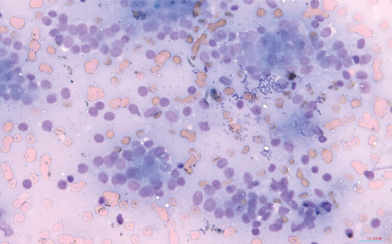 Imagen 1.﻿ Citología tomada por PAF compatible con carcinoma de sacos anales.﻿