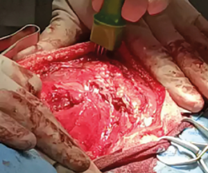 Tratamiento intraoperatorio sobre el lecho quirúrgico de un mastocitoma subcutáneo mediante la técnica concéntrica.