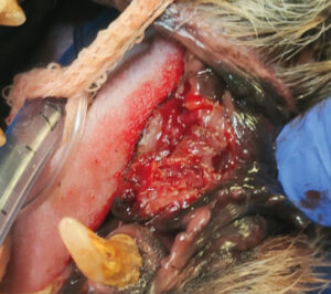 Imagen del lecho tumoral tras la extirpación quirúrgica del melanoma oral de la imagen 18﻿, antes del inicio del tratamiento con electroquimioterapia.